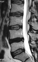 Diskojenik Bel Ağrısı