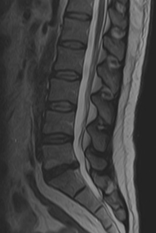 lomber-disk-hernisi-bel-bacak-agrisi-transforaminal-epidural-enjeksiyon-sagittal