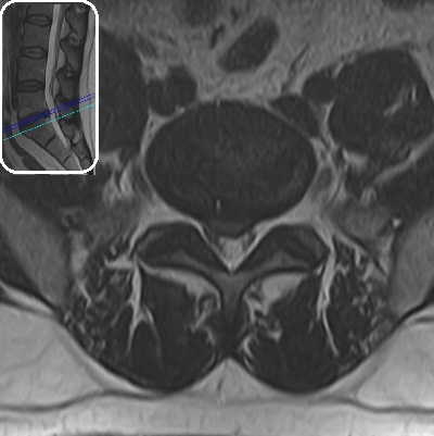 lomber-disk-hernisi-bel-bacak-agrisi-transforaminal-epidural-enjeksiyon-aksial