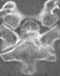 Os odontoideum thumbnail
