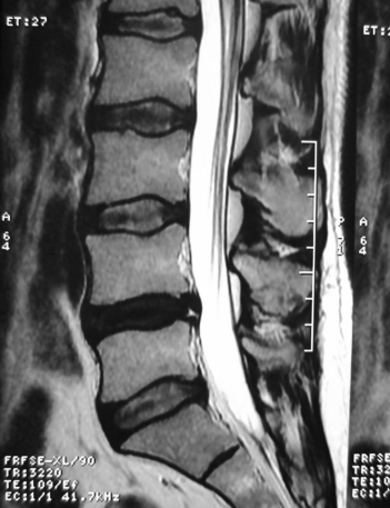 Lomber MRG - L4-L5 Disk Dejenerasyonu ve HIZ