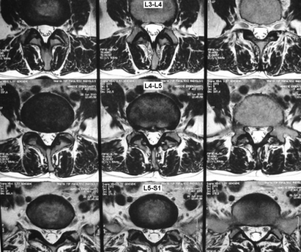 Lomber MRG Aksiyal Kesit - Anüler Yırtık