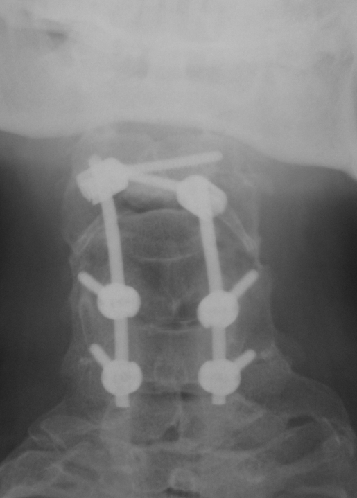 Klippel-Feil PostOp AP Grafisi