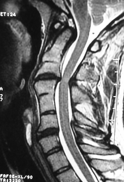 Klippel-Feil Sendromu Servikal MRG
