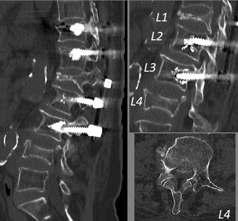 L4 vertebra kırığı BT