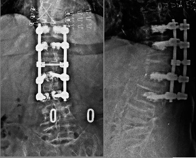 Eski sementli T11-L3 vida sistemi