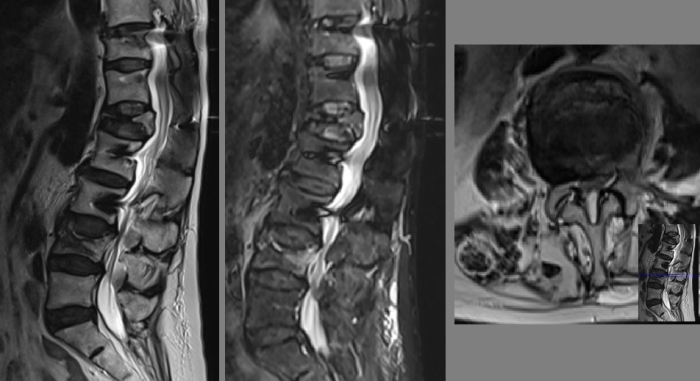 L4 vertebra kırığı MRG
