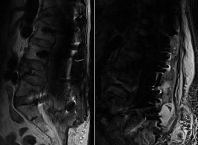 Metal artefaktlı MRG