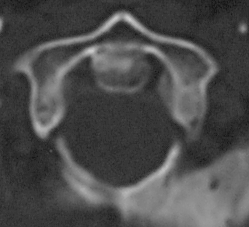 Aksiyal BT Kesiti - Atlas Füzyonu