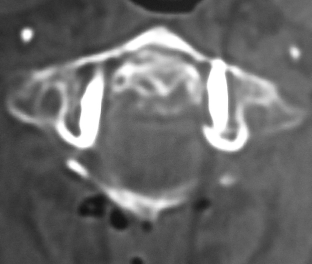C1 Lateral Kitle Vidaları BT