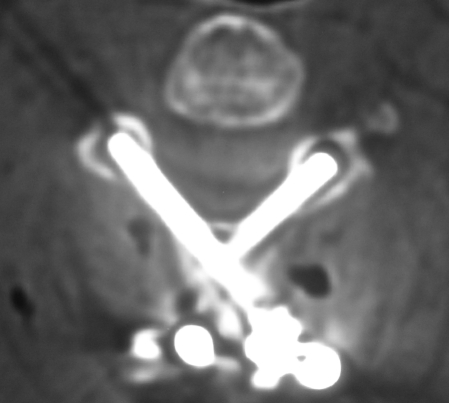 C2 Intralaminar Vidalar BT