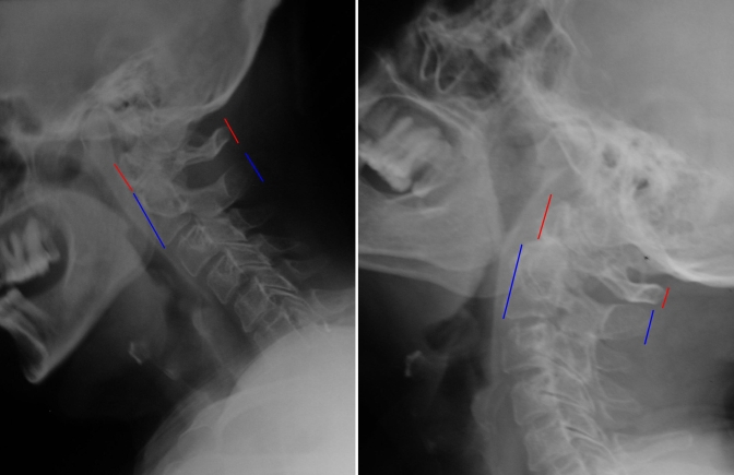 Fonksiyonel Servikal Grafi - İnstabilite