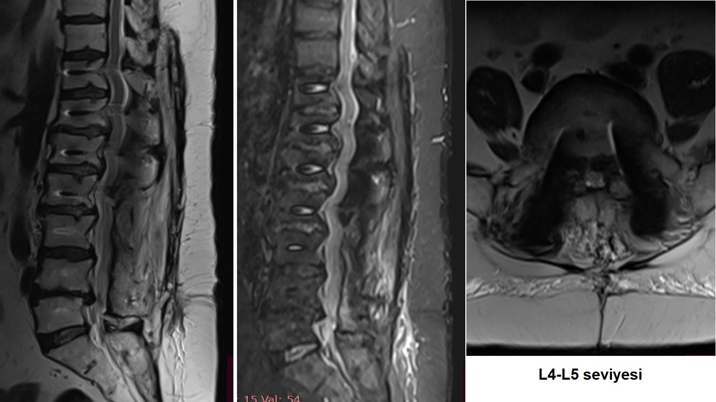2021 Yılı MRG İncelemesi - Lomber Enstrüman Gevşemesi