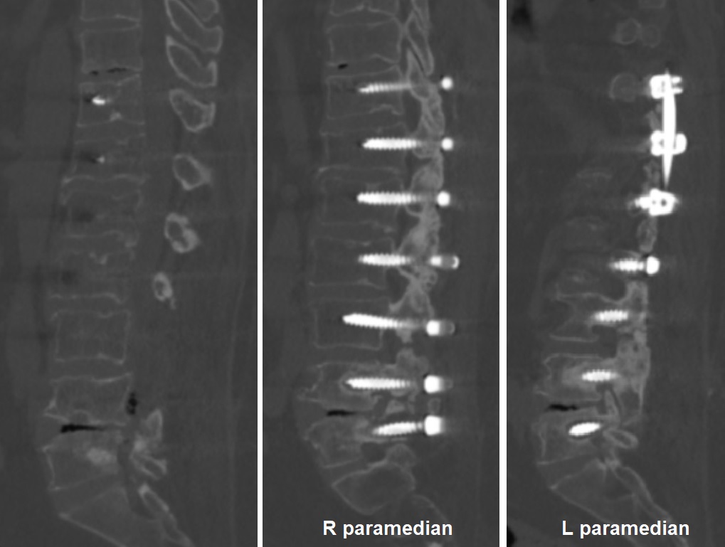 2022 Yılı BT İncelemesi - Vida Gevşemesi