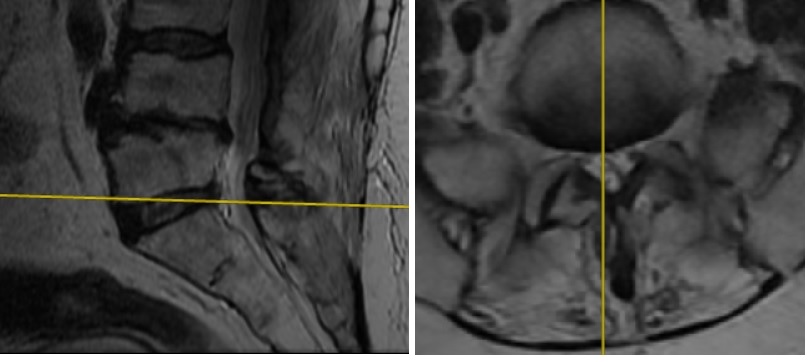 L5-S1 MRG Değerlendirmesi