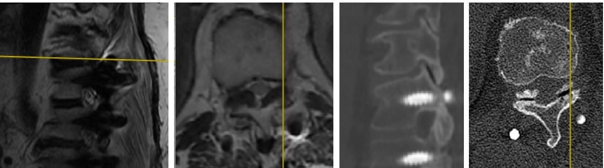 T10-T11 Sol Taraf Değerlendirmesi