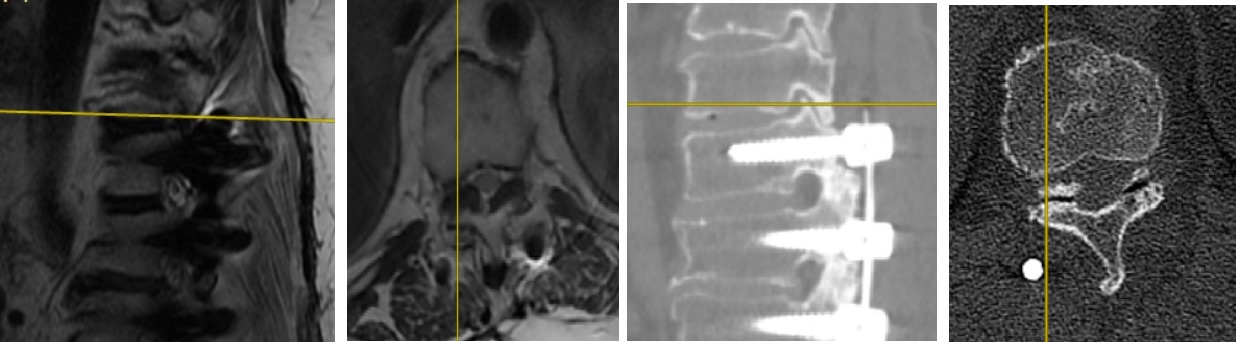 T10-T11 Sağ Taraf Değerlendirmesi