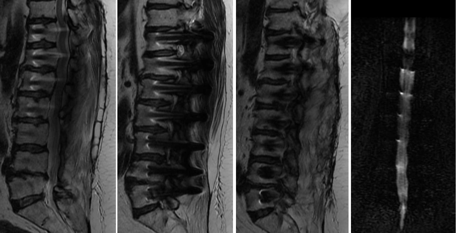 2022 Yılı MRG İncelemesi ve Myelografi
