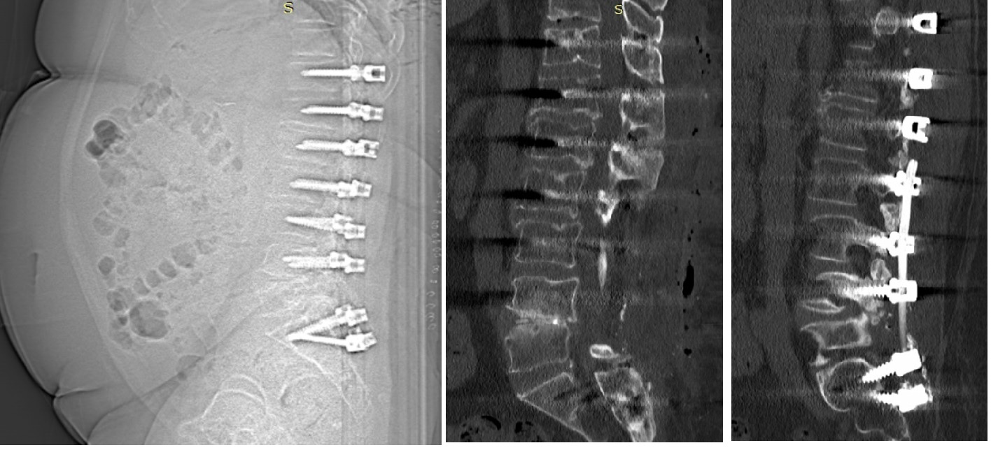 Postop AP Radyolojik Görüntü