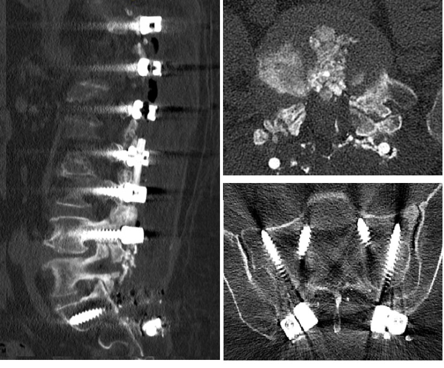 Postop Lateral Radyolojik Görüntü