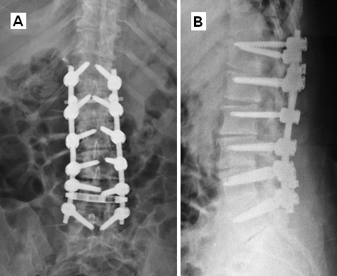 Postoperatif L3-L5 Füzyon Grafisi