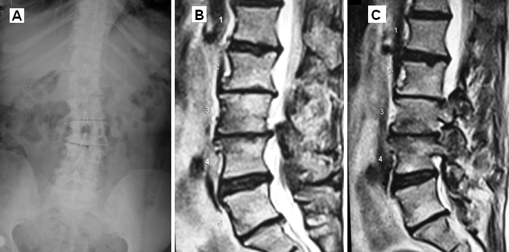 Dejeneratif Lomber Skolyoz Direkt Grafisi