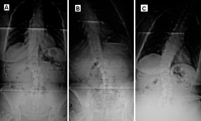 Lomber Skolyoz MRG Spinal Stenoz