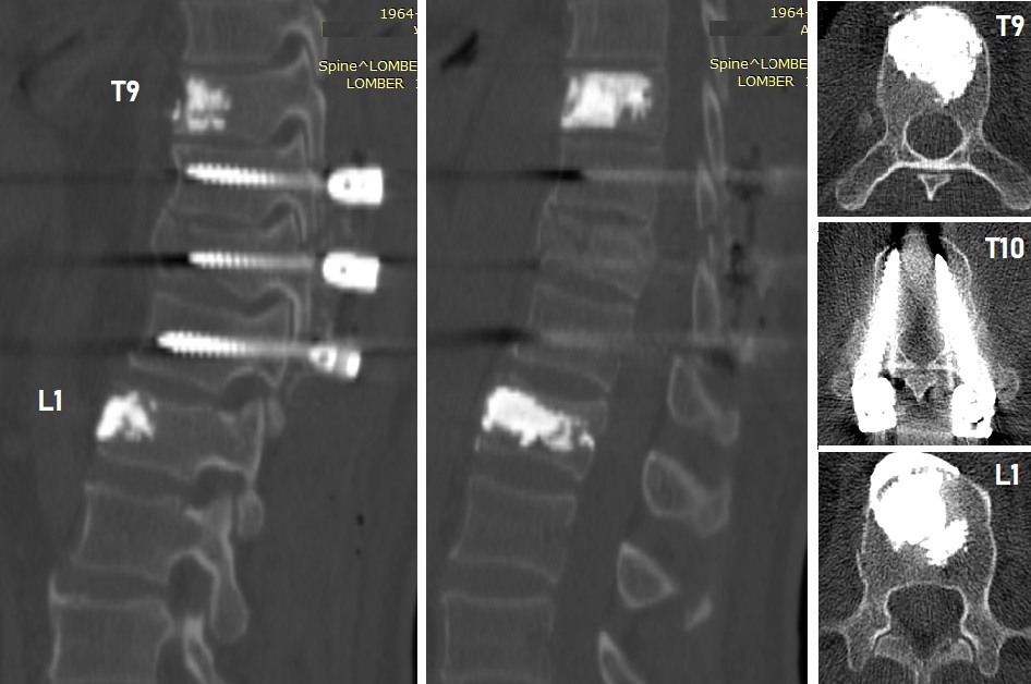 Postoperatif Direkt Grafi - Kifoplasti ve Stabilizasyon