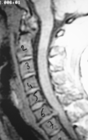 1999 Tarihli Servikal MRG - Os Odontoideum