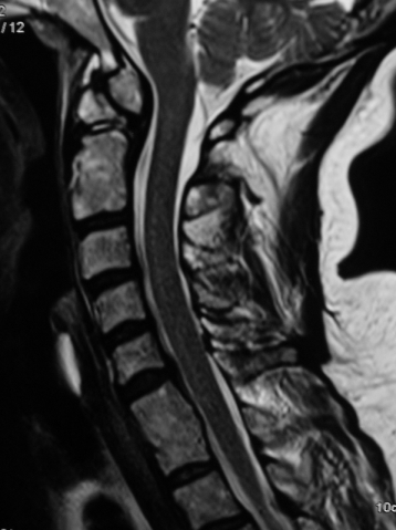 Güncel Servikal MRG - Os Odontoideum ve C1 Kayması
