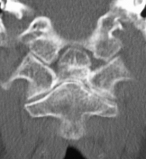 Koronal BT Kesiti - Os Odontoideum